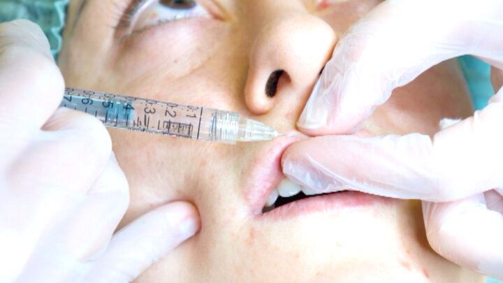 Serial Lip Filler